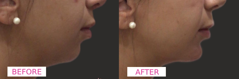 Chin Filler Before & After