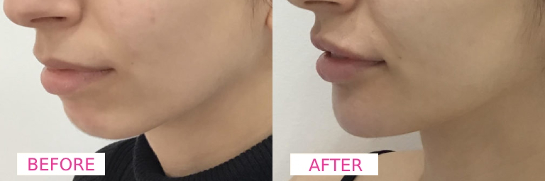 Chin Filler Before & After