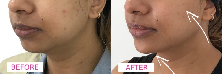 Chin Filler Before & After