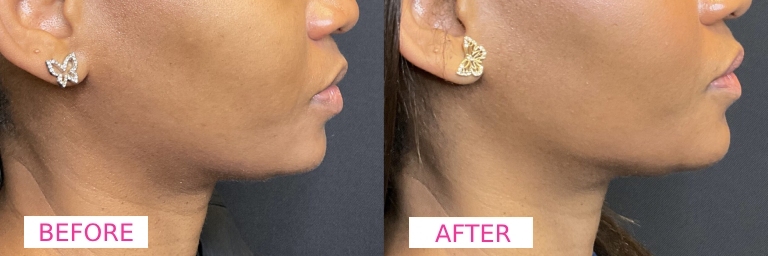 Chin Filler Before & After