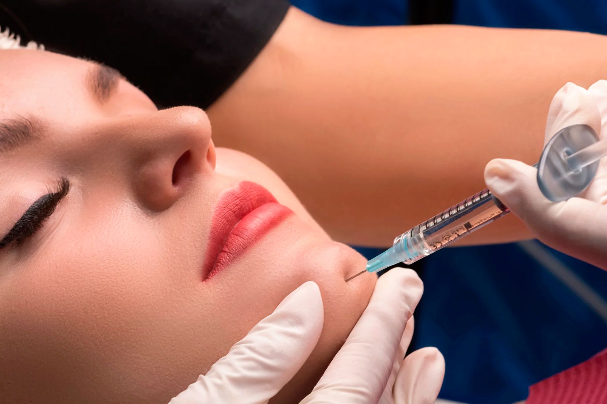 Dermecare Chin Filler Procedure