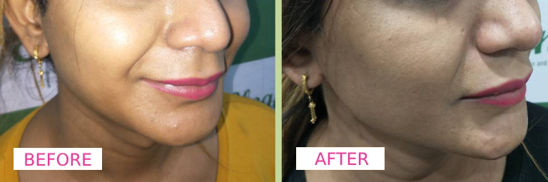 Dermecare Jawline Filler