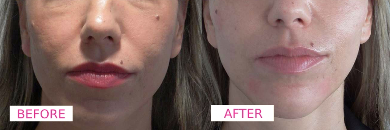 Dermecare Jawline Filler