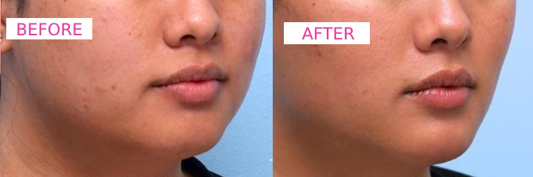 Dermecare Jawline Filler