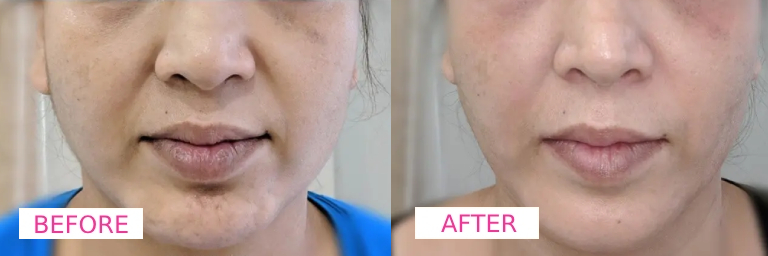 Dermecare Jawline Filler