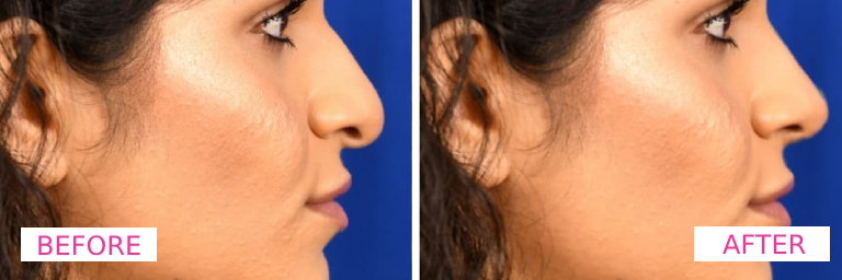 Dermecare Nose Filler