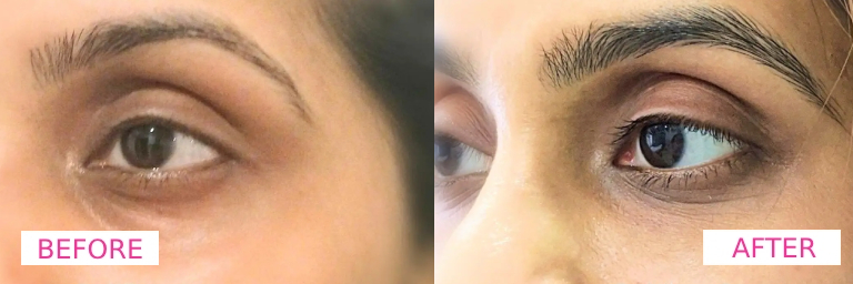 Dermecare Under Eye Filler