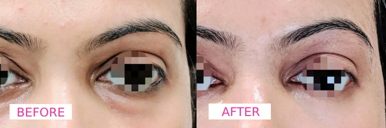 Dermecare Under Eye Filler