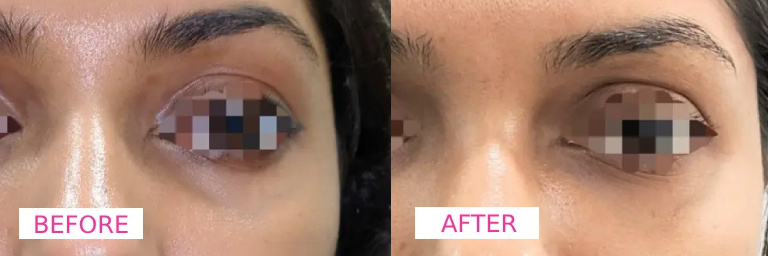 Dermecare Under Eye Filler