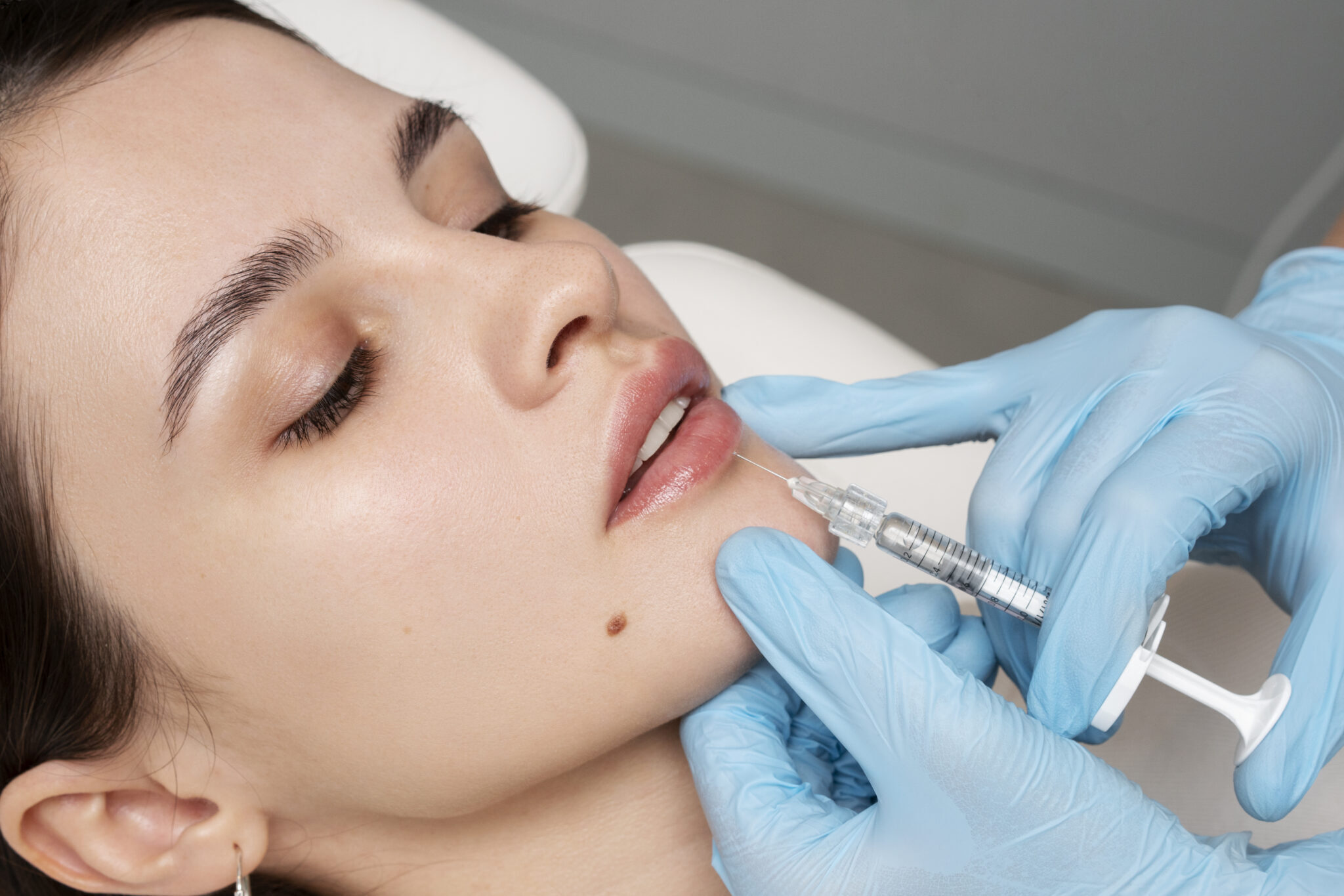 Dermcare Lip Filler procedure