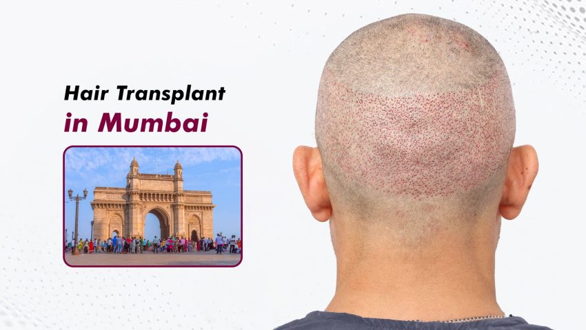 Hair-Transplant-in-Mumbai-2-scaled