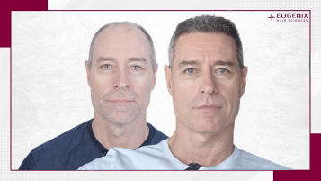 michael-bevan-hair-transplant-results-2